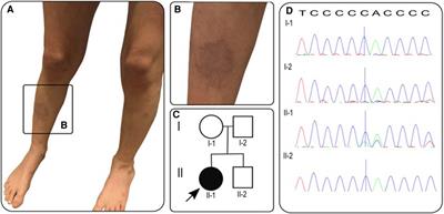 Case report: marfan syndrome (MFS) mimicking cutaneous vasculitis